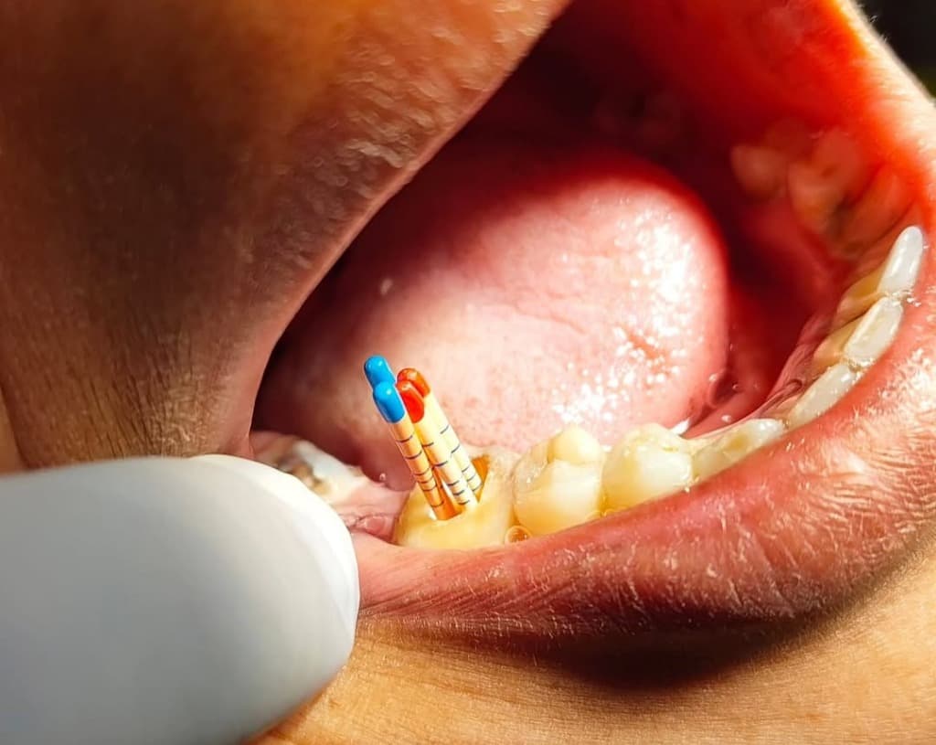 Root Canal Treatment Procedure