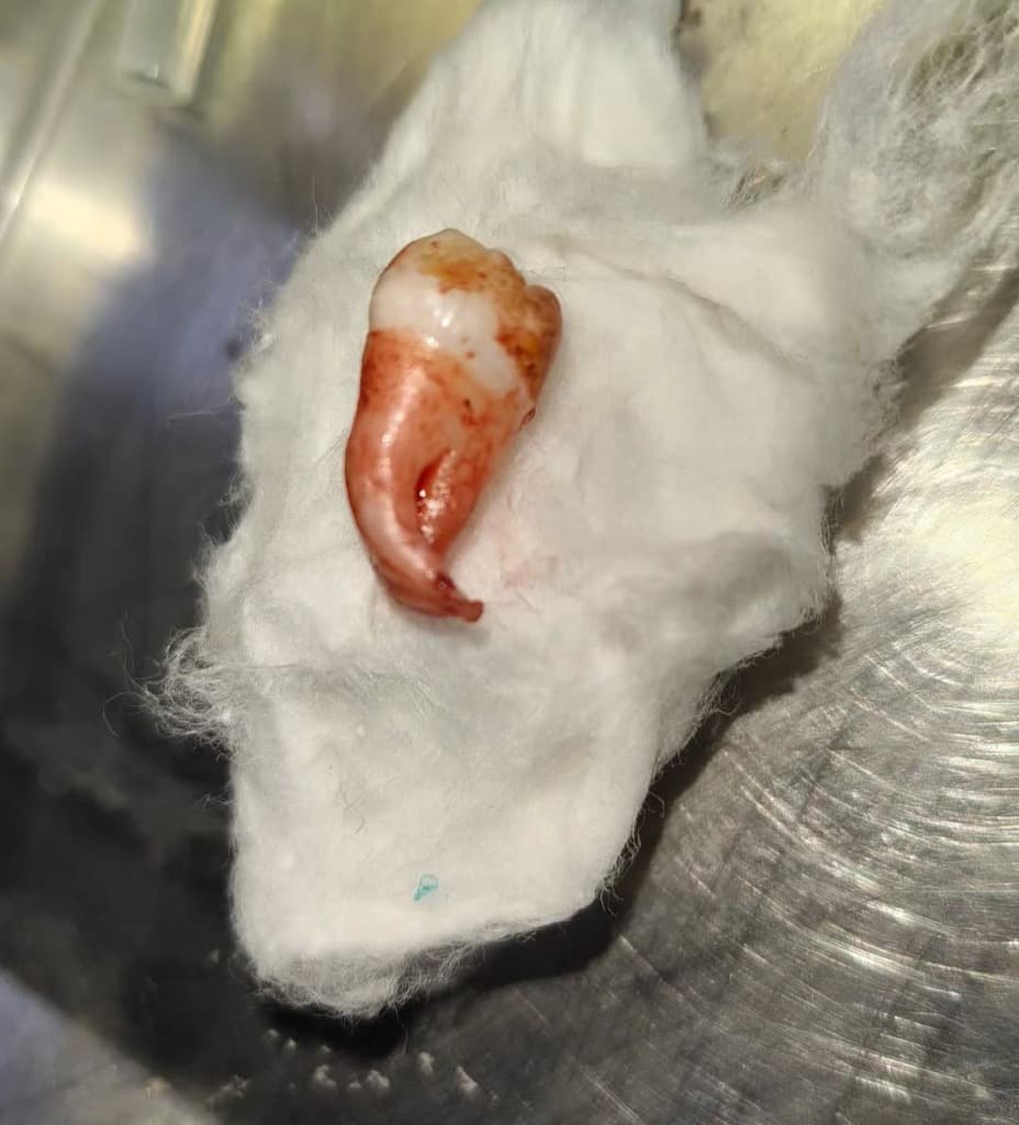 Precision Tooth Extraction